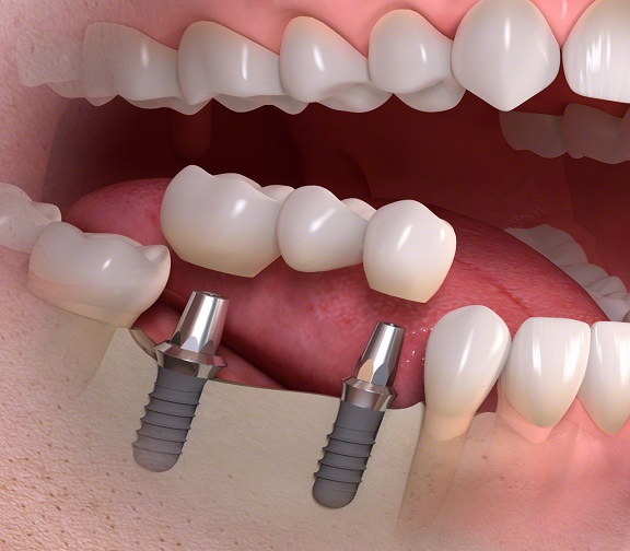 genoeg Eerlijk Bepalen Kroon- en brugwerk op implantaten - Kaakchirurg Limburg