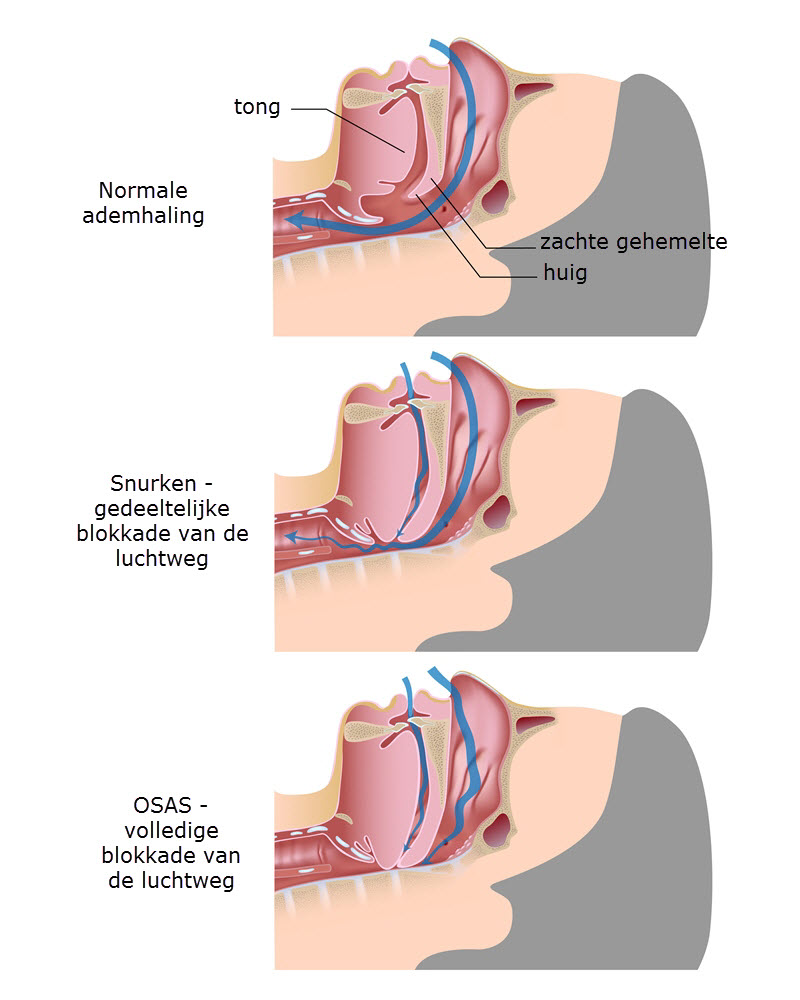 Wat is slaap apneu syndroom, OSAS en snurken ?