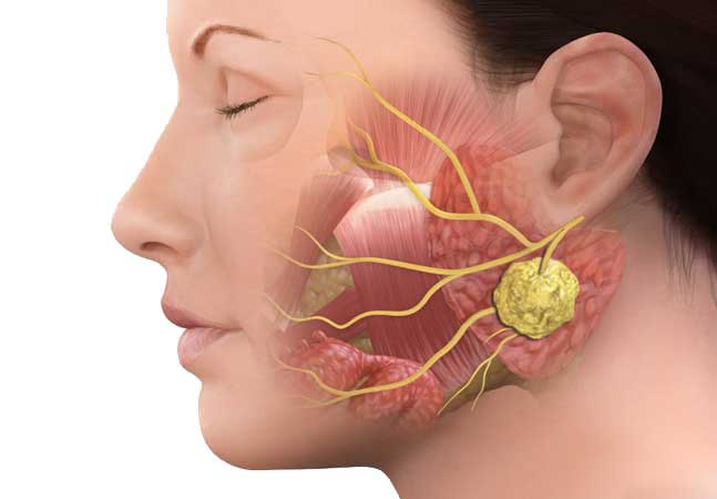 Parotidectomie